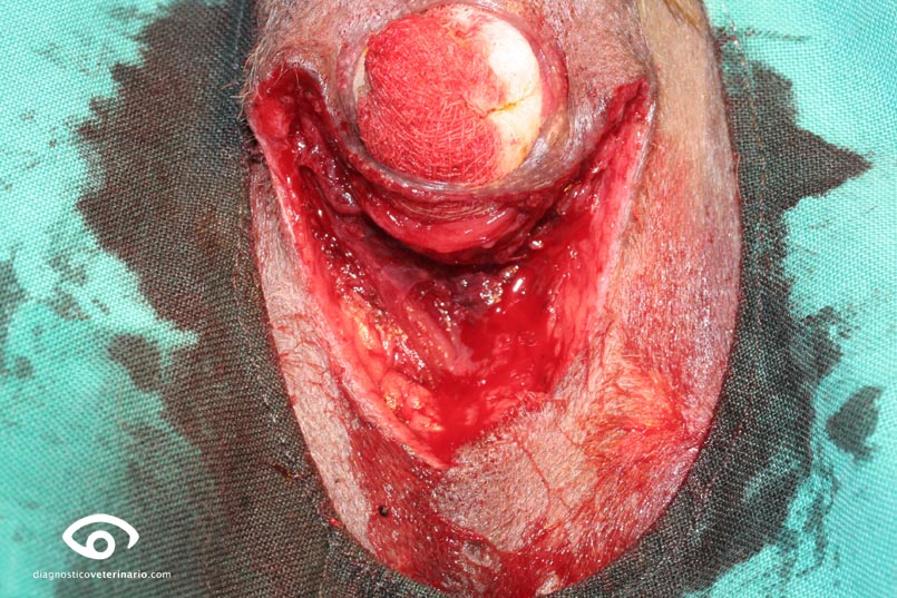cirugia circumanales excisión